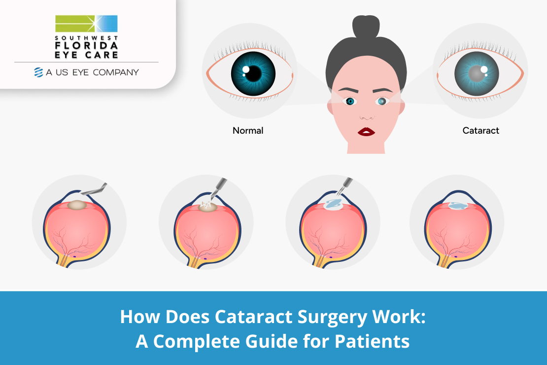 Cataract Surgery Work A Complete Guide