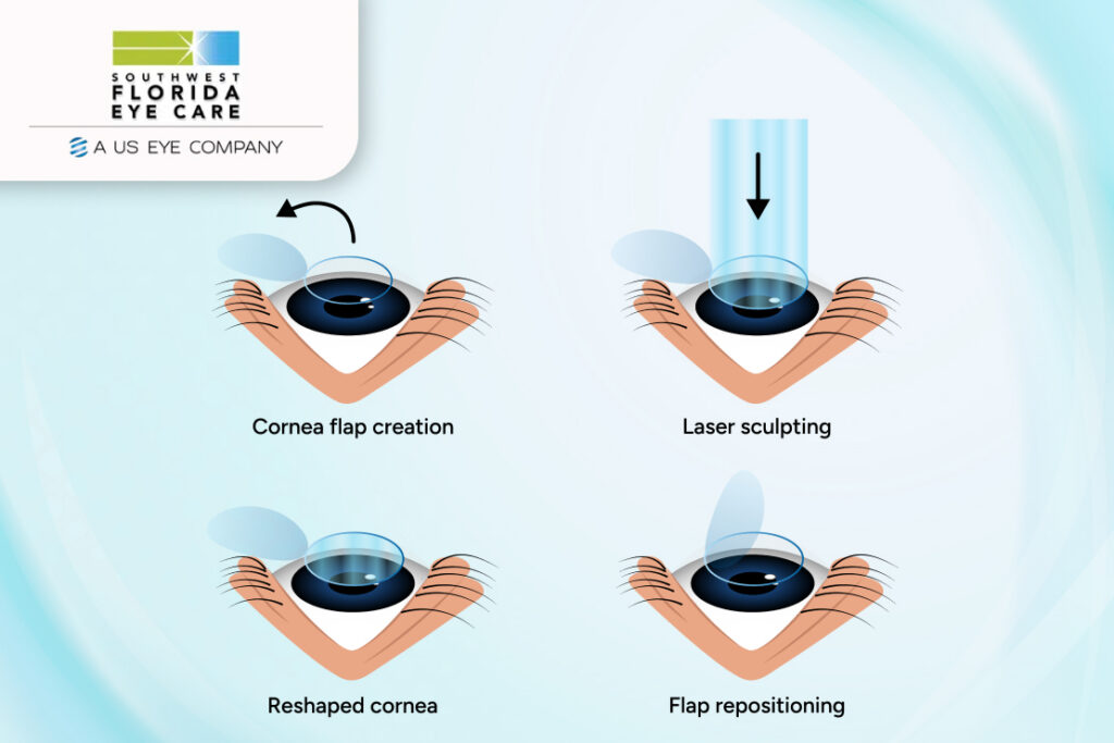 LASIK Eye Surgery
