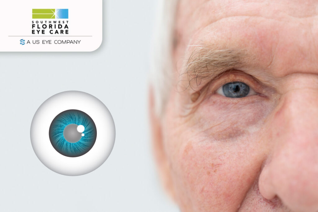 Cataracts vs. Glaucoma