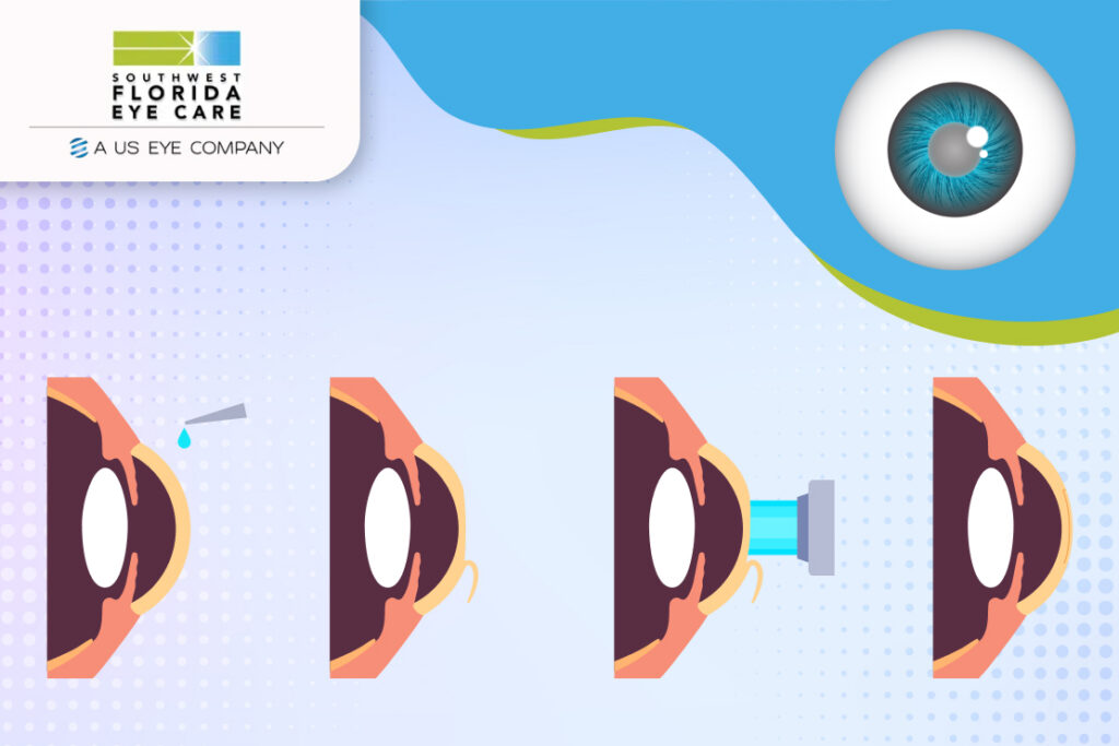 Laser Eye Surgery for Glaucoma