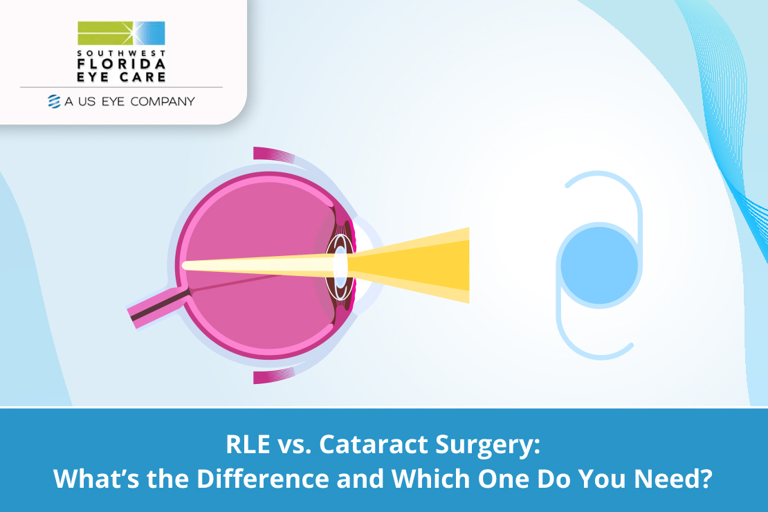 RLE vs. Cataract Surgery