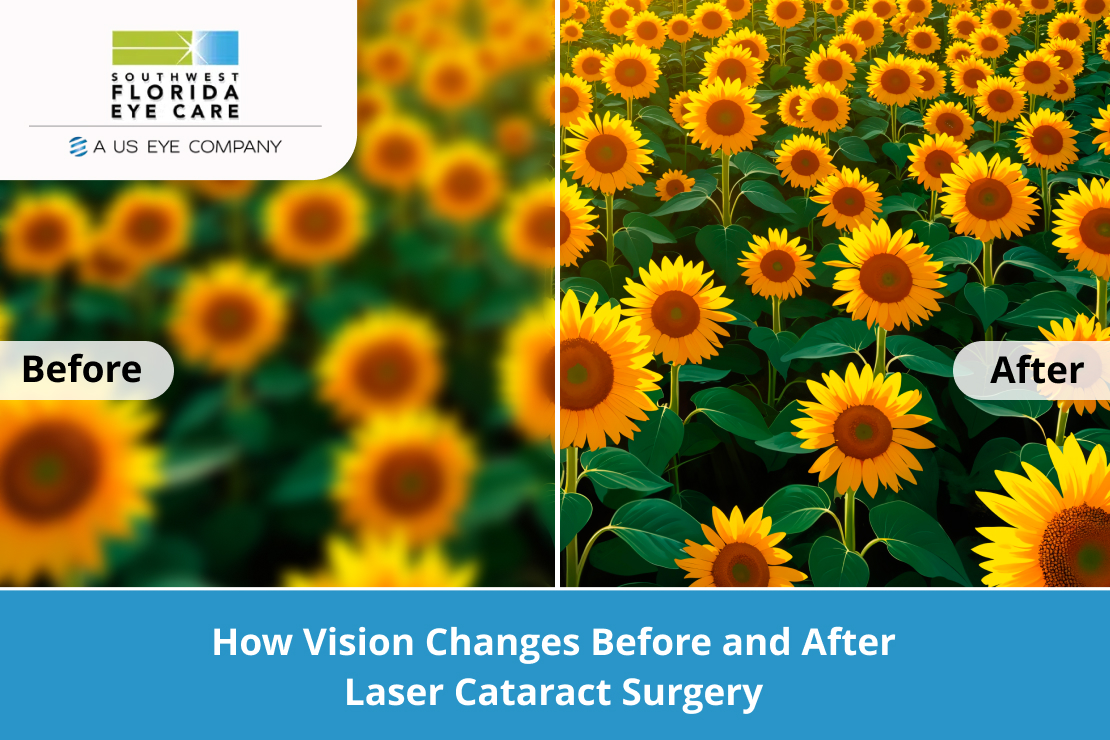 Before and After Laser Cataract Surgery